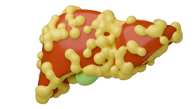 Fat covering liver for fatty liver disease.