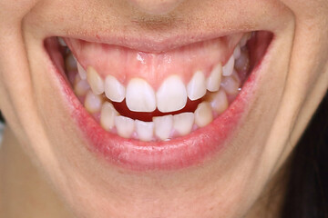 smile of a woman with a lot of gum