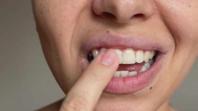 Close up of a young caucasian woman applying mineralizing gel to teeth for strengthening, restoring and whitening on a dark grey background. Dental care, treatment. Prevention of sensitive teeth
