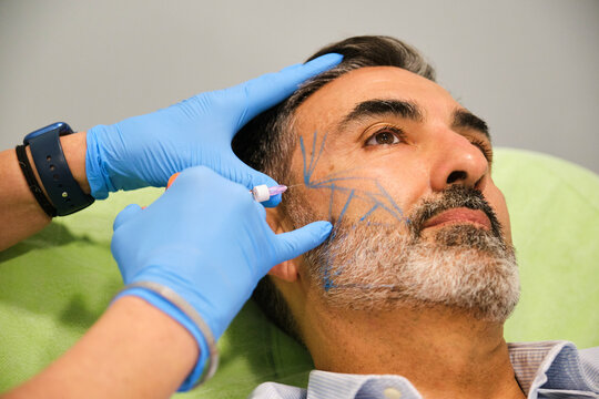 A man is getting a procedure done on his face. A man is getting a cheekbone filler or cheek Botox.