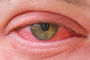 The red eye of a man with conjunctivitis, viral infection with redness of the eyeball protein