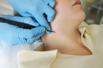 surgeon uses a radio wave knife to remove a neoplasm - a mole or nevus on the neck of a female...