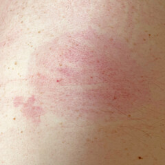 Red spot or Erythema migrans on the skin due to Lyme disease