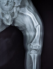 X ray of thigh showing femur fracture and metaphyseal flaring , bowed femur xray of a child with...