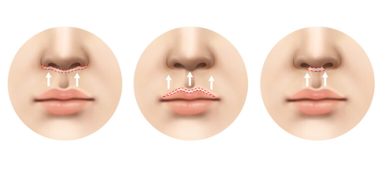 philtrum