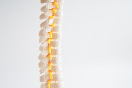 Spinal nerve and bone, Lumbar spine displaced herniated disc fragment, Model for treatment medical in the orthopedic department.
