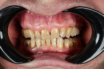 Wedge-shaped (cone-shaped) section of enamel loss in the area of the tooth neck. Destruction of the...