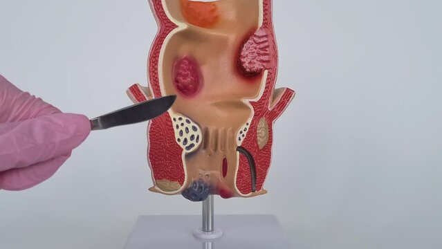 Doctor is holding scalpel anatomy of rectum problem. Surgical approach to treatment of chronic constipation