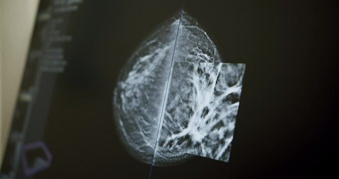 Closeup handheld shot of mammogram of breast on computer monitor during cancer examination in laboratory of modern clinic. high-performance Mammography device in a modern hospital.