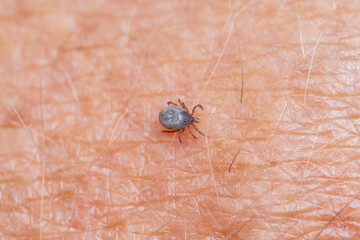 A tick on the skin that transmits dangerous diseases such as tick-borne encephalitis or Lyme disease.
