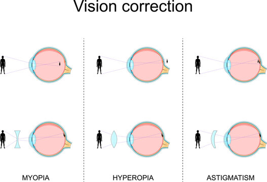 Vision defects. Myopia, Hyperopia, Astigmatism. Vision Correction