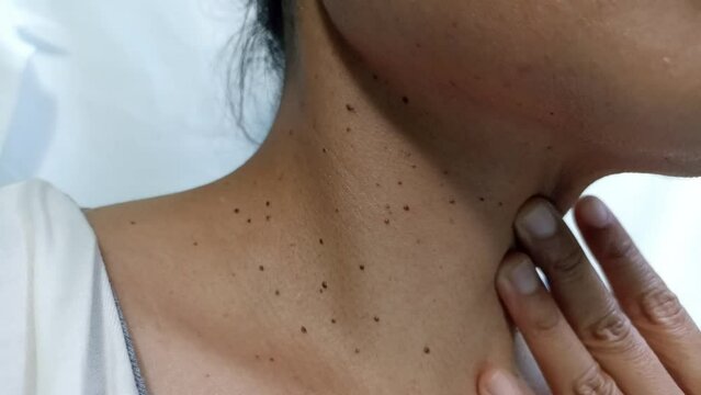 Closed up the skin tags on woman's neck. Acrochordon. Health care concept. Woman showing her neck's skin with skin tag.
