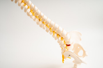 Lumbar spine displaced herniated disc fragment, spinal nerve and bone. Model for treatment medical...