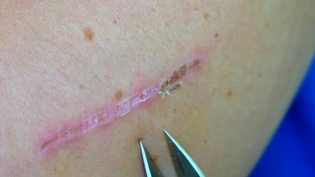 Treating a deep cut on the hand with medical instrument. Scar on hand. Cut and wound in the skin. Closeup