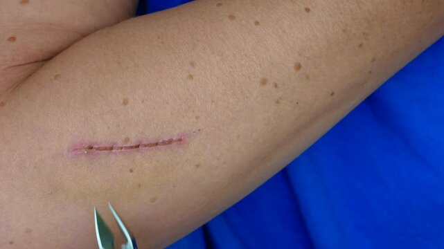 Treating a deep cut on the hand with medical instrument. Scar on hand. Cut and wound in the skin. Closeup