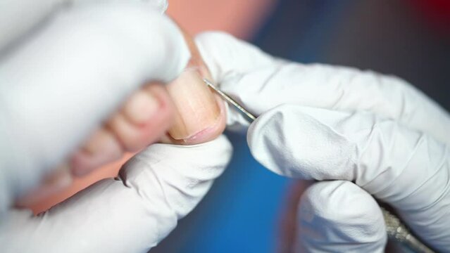 Pedicure, podologist. Patient on medical pedicure procedure, nail disease