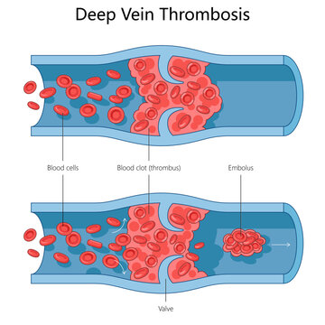 formation of a blood clot in a vein, representing Deep Vein Thrombosis DVT and its progression structure diagram hand drawn schematic vector illustration. Medical science educational illustration