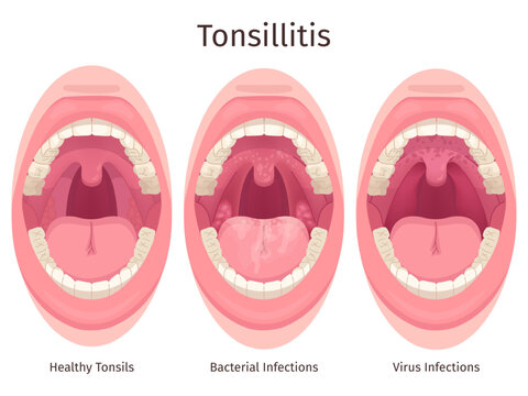Tonsils. Human sore throat airways inflammation tonsil lymph and tongue in open mouth, bacteria swollen glands pharyngitis tonsillolith disease symptom, swanky illustration