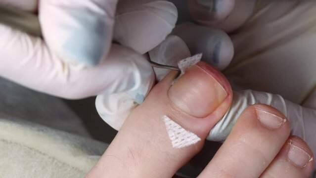 Medical pedicure, podiatrist doing tamponade to a deformed toenail
