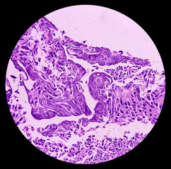 Urinary bladder cancer. Transitional cell carcinoma. show malignant neoplasm, 40x view.	
