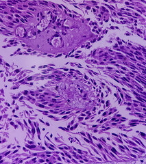 Urinary bladder cancer. Transitional cell carcinoma. show malignant neoplasm, 40x view.	
