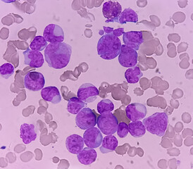 Acute myeloid leukemia (AML). Smear show monocytes and mostly blast cell. Anemia and...