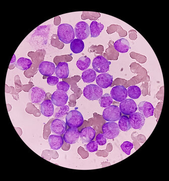 Acute myeloid leukemia (AML). Smear show monocytes and mostly blast cell. Anemia and thrombocytopenia. Most common acute leukemia affecting adults.