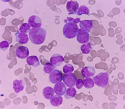 Acute myeloid leukemia (AML). Smear show monocytes and mostly blast cell. Anemia and thrombocytopenia. Most common acute leukemia affecting adults.