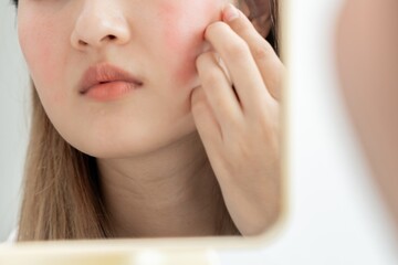 woman asian are worried about faces Dermatology and allergic to steroids in cosmetics. sensitive...