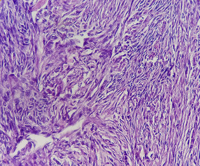 Microscopic image of Papillary borderline serous tumor of the ovary (low malignant potential) with...