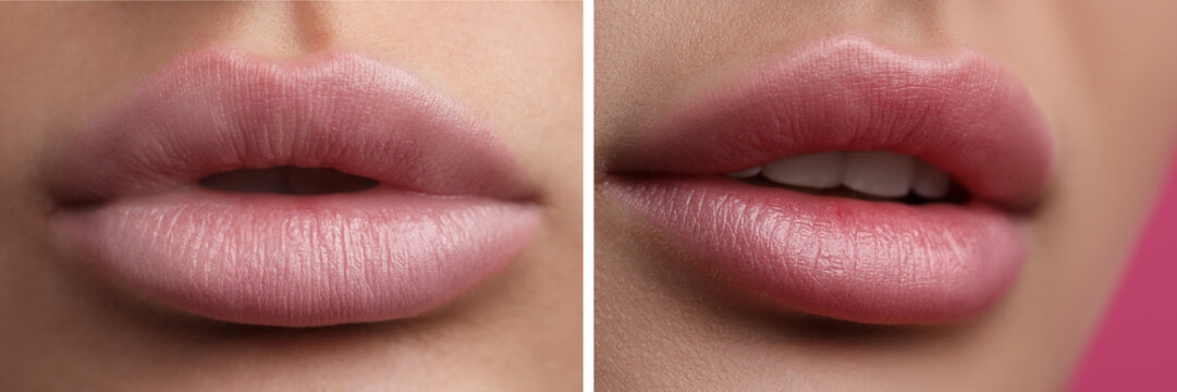 Permanent makeup. Collage with photos of woman before and after lip blushing, closeup