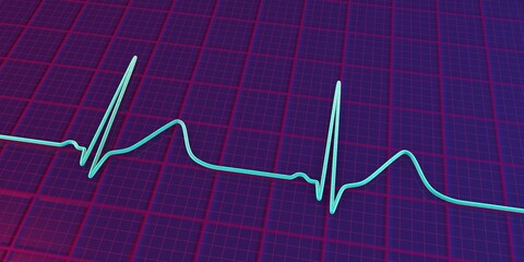 Long QT syndrome ECG, 1st type, 3D illustration