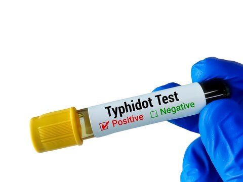 Blood sample for Typhidot test, to detect IgG and IgM antibodies for typhoid fever