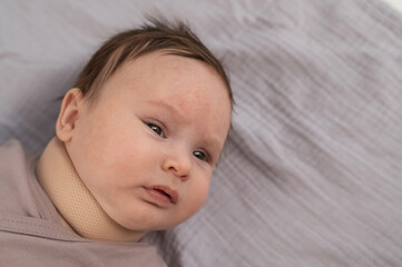 Top view of a newborn baby wearing an orthopedic collar.