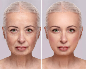 Portrait of an elderly woman before and after skin resurfacing and cosmetic procedures.
