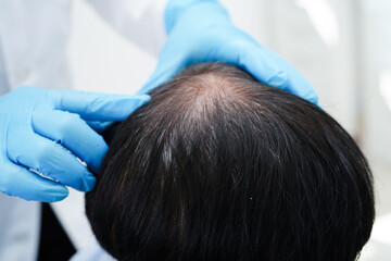 Doctor touch bold head in man, hair loss treatment health problem.