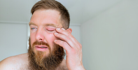 Obraz premium Male patient's infected eye. The blue-eyed bearded man staring at the camera has an external stye bacterial infection. Hordeolum on upper eyelid. Viral Infection. Staphylococcus. Ophthalmology 