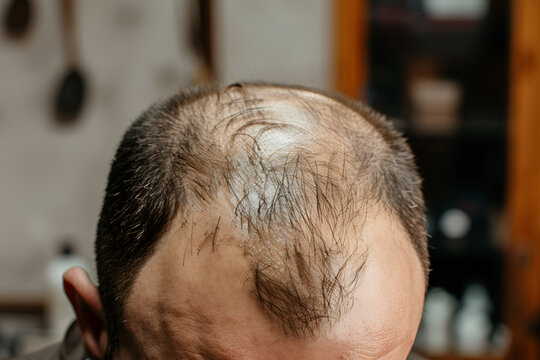 Bald patch on a man's head against a blue sky.