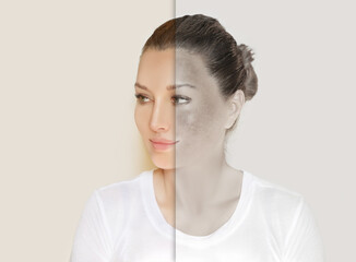 Fototapeta premium Dark spots, freckles,hyperpigmentation(melasma or chloasma),concept - skin lightening, skin whitening, fruit acids,AHA, Skin Brightening