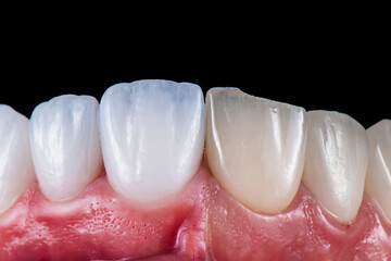 before after in one picture replaced old emax crowns