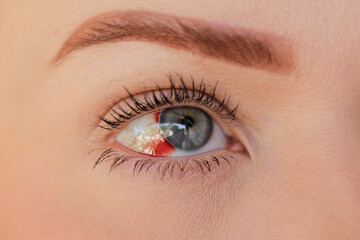 Obraz premium Blue eye on the right side of a woman, without identifying the person, with ocular hemorrhage, highlighting the red bleeding in this eye.