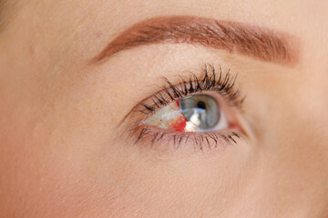 Blue eye on the right side of a woman, without identifying the person, with ocular hemorrhage,...