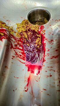 Human feces with blood. Blood in stool caused by hemorrhoids.