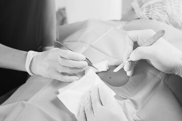 Doctor and nurse during birthmark removal dermatologic surgery