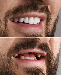 complex dental treatment case with crowns  implants and veneers