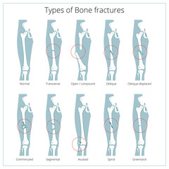 Types of bone fractures medical skeleton anatomy educational PNG illustration. Medical science
