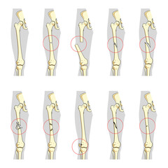 Types of bone fractures medical skeleton anatomy educational PNG illustration. Medical science