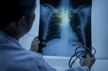 Doctor hand point patient lung x-ray film before treatment for diagnosis pneumonia, pulmonary...