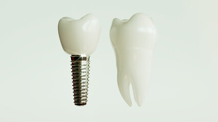 Dental Implant Comparison 3D Rendering