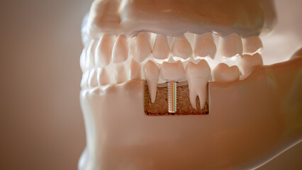 Dental Implant Procedure 3D Rendering